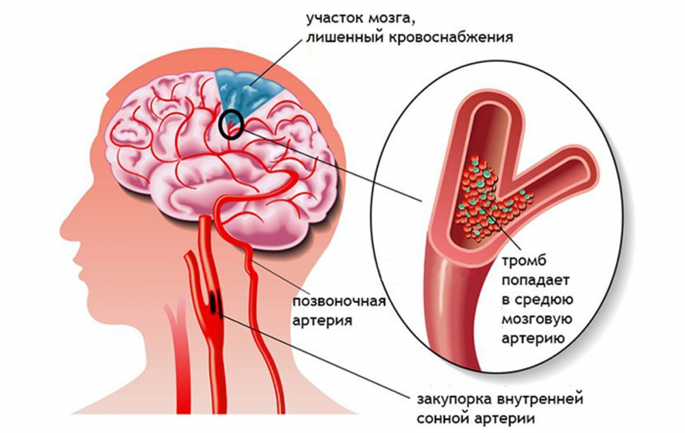 Инсульт – первая помощь! Это НУЖНО знать каждому! – В Курсе Жизни